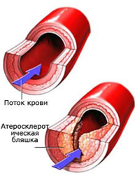 Низкоуглеводная диета провоцирует атеросклероз